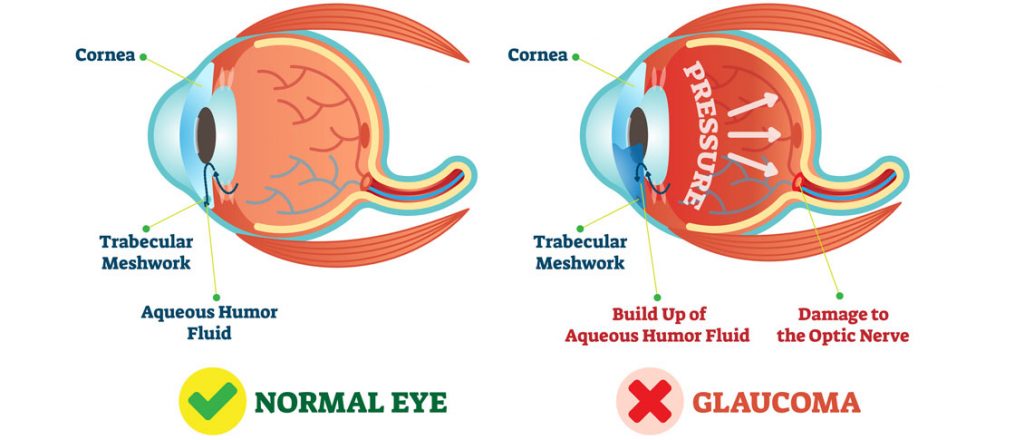 glaucoma diagram