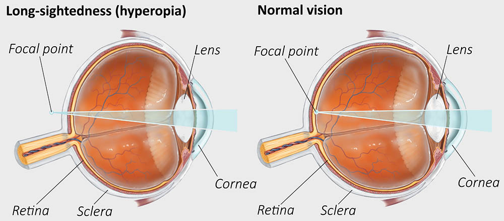 a diagram showing the light refraction in an eye with and without long-sightedness
