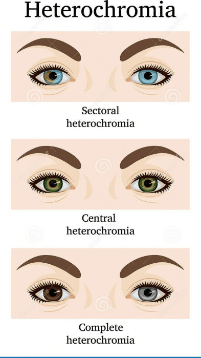 humans with two different eye colors