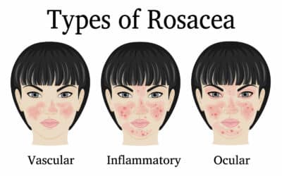 Occular Rosacea